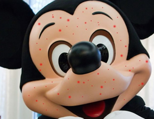 Mickey Mouse with Measles