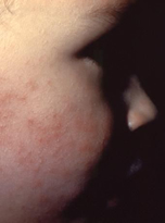 child with rash on face