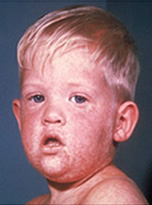 boy with measles rash