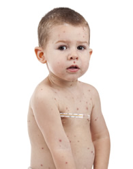 chickenpox