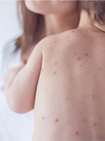 chicken pox