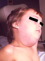 boy with mumps