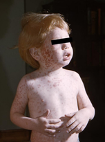 Can measles vaccine cause injury and death?